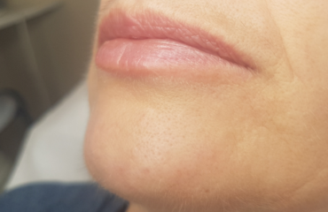 Mary – facial 1st